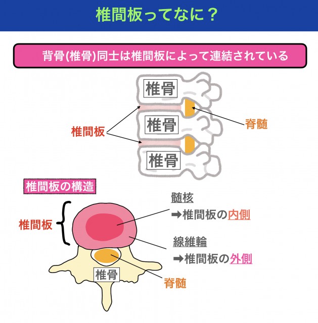 髄核が飛び出ちゃう病気 椎間板へルニアを腰と頸に分けて詳しく知ろう メンズ看護師の病態講座 Vol 2 椎間板ヘルニア編 ナースときどき女子