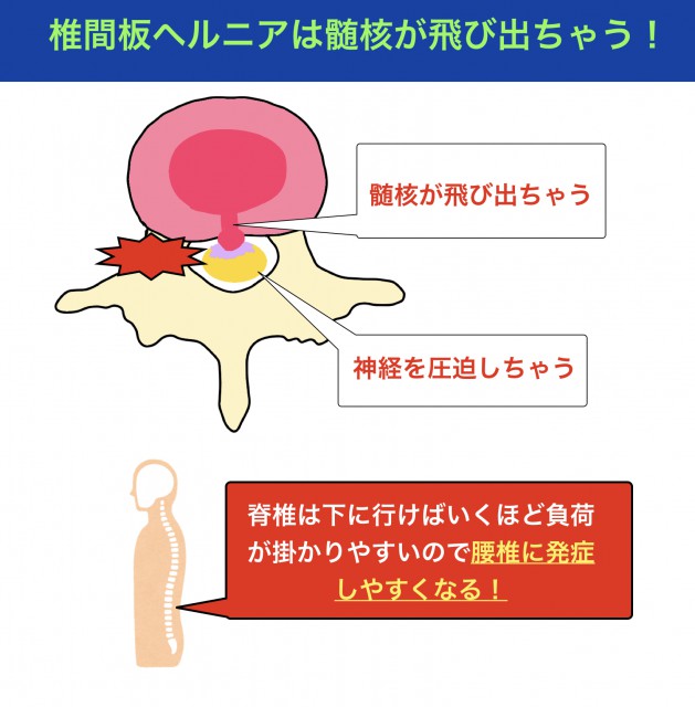 髄核が飛び出ちゃう病気 椎間板へルニアを腰と頸に分けて詳しく知ろう メンズ看護師の病態講座 Vol 2 椎間板ヘルニア編 ナースときどき女子