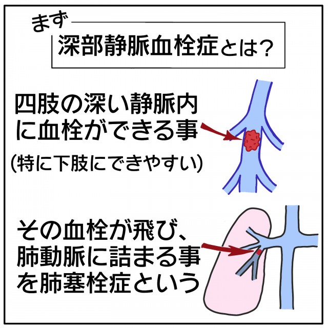 肺血栓に至ったら大変 四肢にできる深部静脈血栓をしっかり学ぼう Chikaさんの医療講座 Vol 34 ナースときどき女子