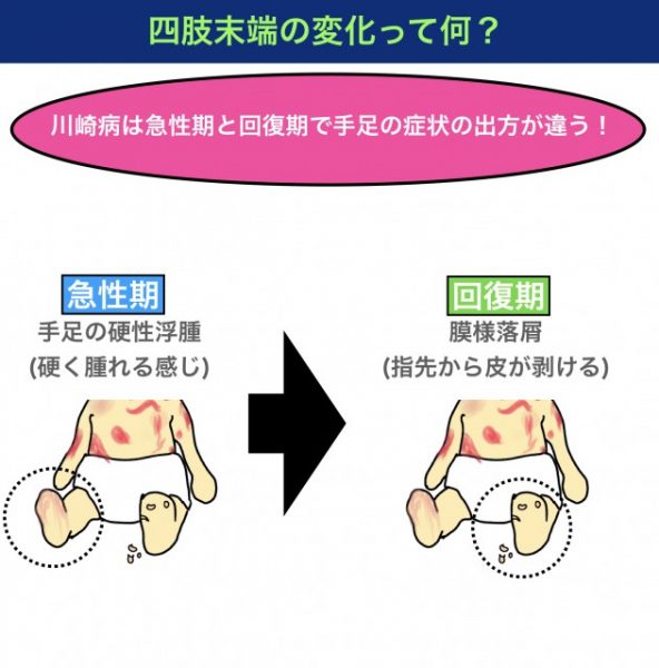 幼児に発熱、発疹、イチゴ舌u2026 は川崎病のサイン！じつは血管の病気で 