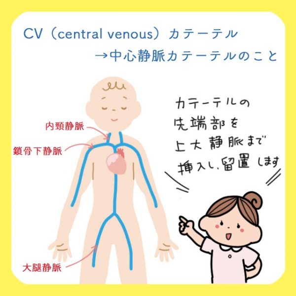 Cvカテーテルとcvポート どう違うの それぞれの適応 メリット デメリットを解説 コタエンジェルのハテナース解説講座 Vol 26 レバウェル看護 お役立ち情報