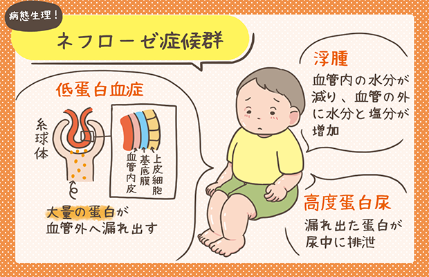 ネフローゼ症候群】病態生理・看護のポイントをわかりやすく解説 