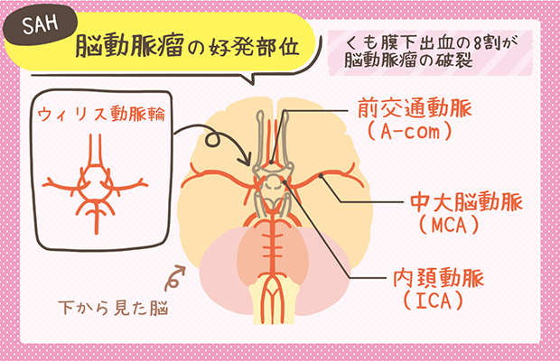 くも膜下出血(SAH)丨病態生理と看護のポイントを解説 くも膜下出血(SAH)丨病態生理と看護のポイントを解説