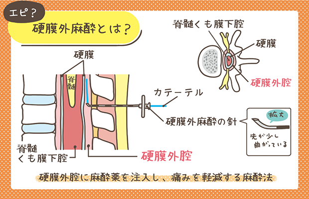 硬膜外鎮痛と麻酔