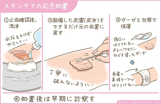 スキンテアの応急処置のやり方のイラスト