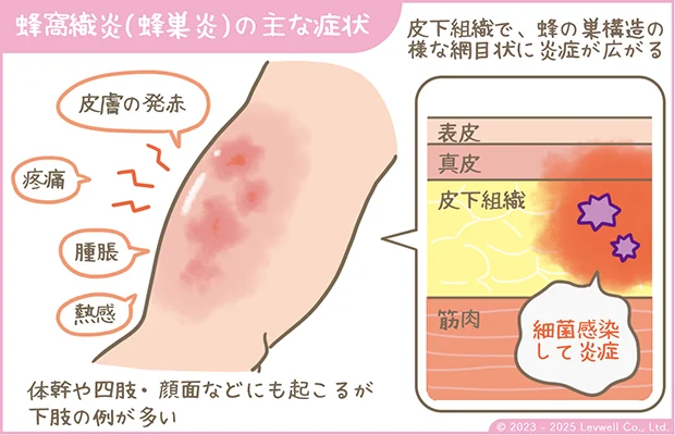 蜂窩織炎の主な症状の解説イラスト