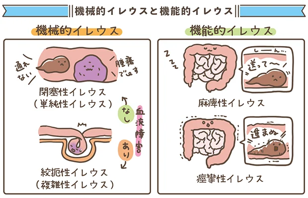機械的イレウスと機能的イレウスの図解イラスト