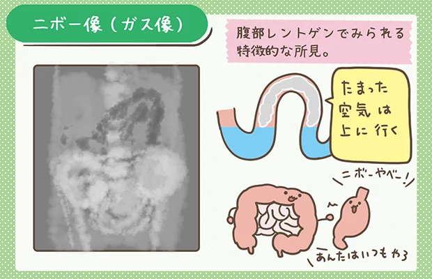 二ボー像（ガス像）の図解イラスト