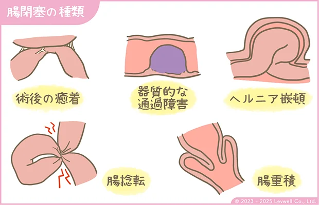 腸閉塞の種類の解説イラスト