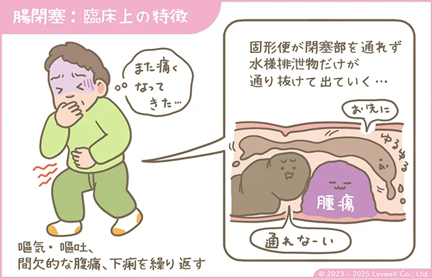 腸閉塞の臨床上の特徴のイラスト