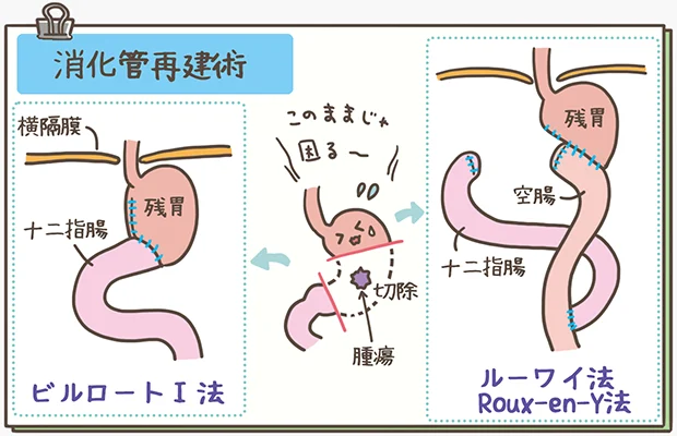 胃がん患者さんへの看護のポイントは？病態生理や看護の実際まで徹底