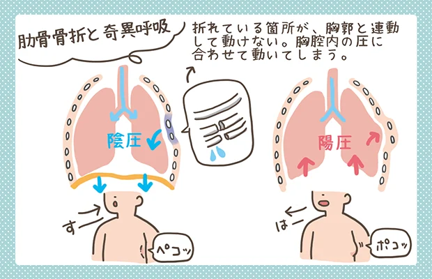 肋骨骨折と奇異呼吸の解説イラスト