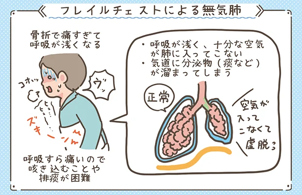 フレイルチェストにより、無気肺を起こしている様子