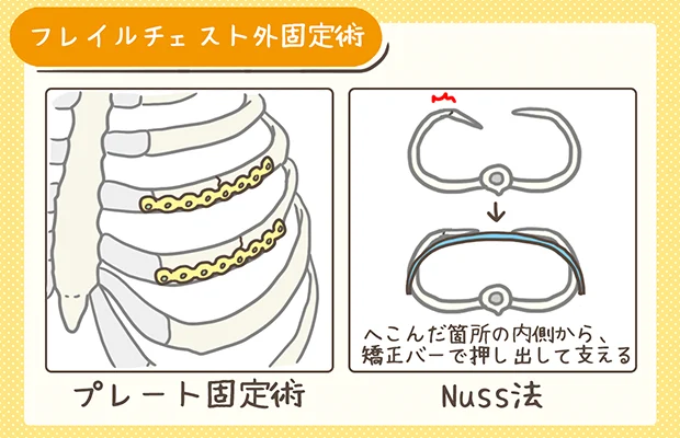 フレイルチェスト外固定術の解説イラスト