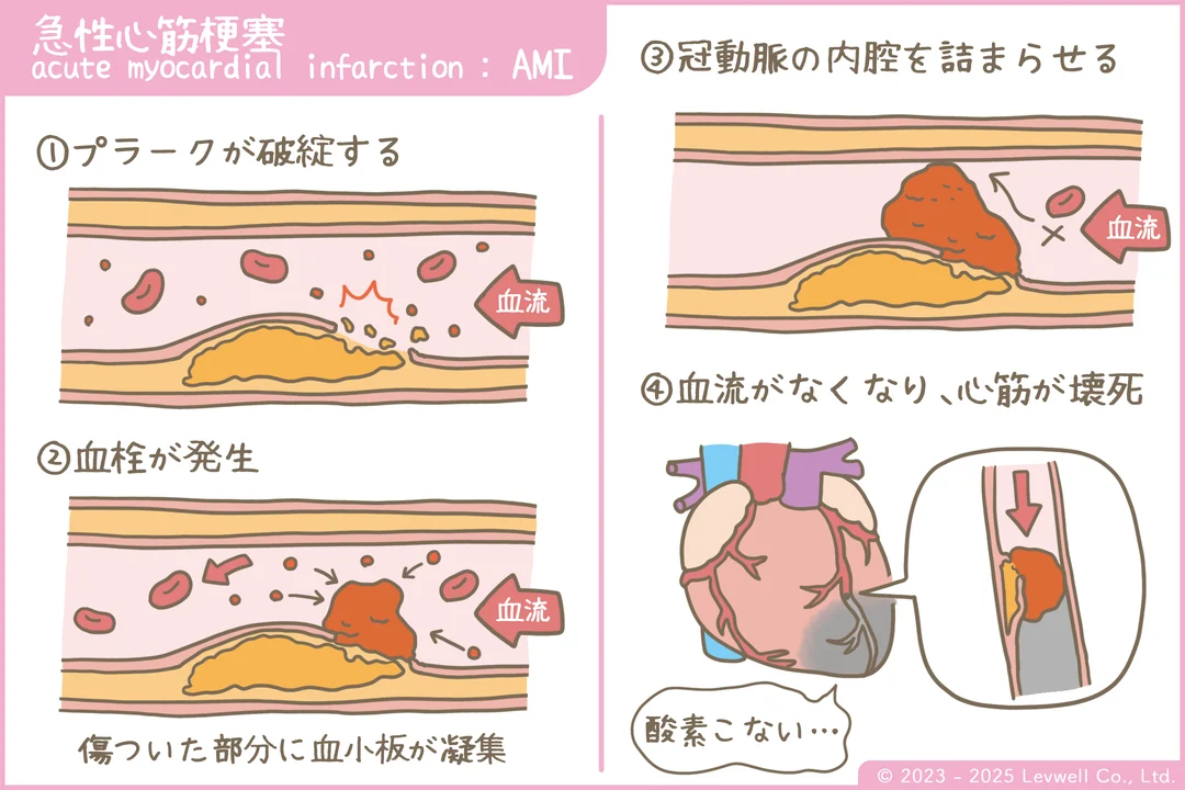 急性心筋梗塞の解説イラスト