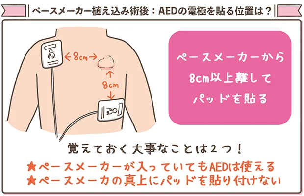 ペースメーカー植込み術後、AEDを貼る位置について