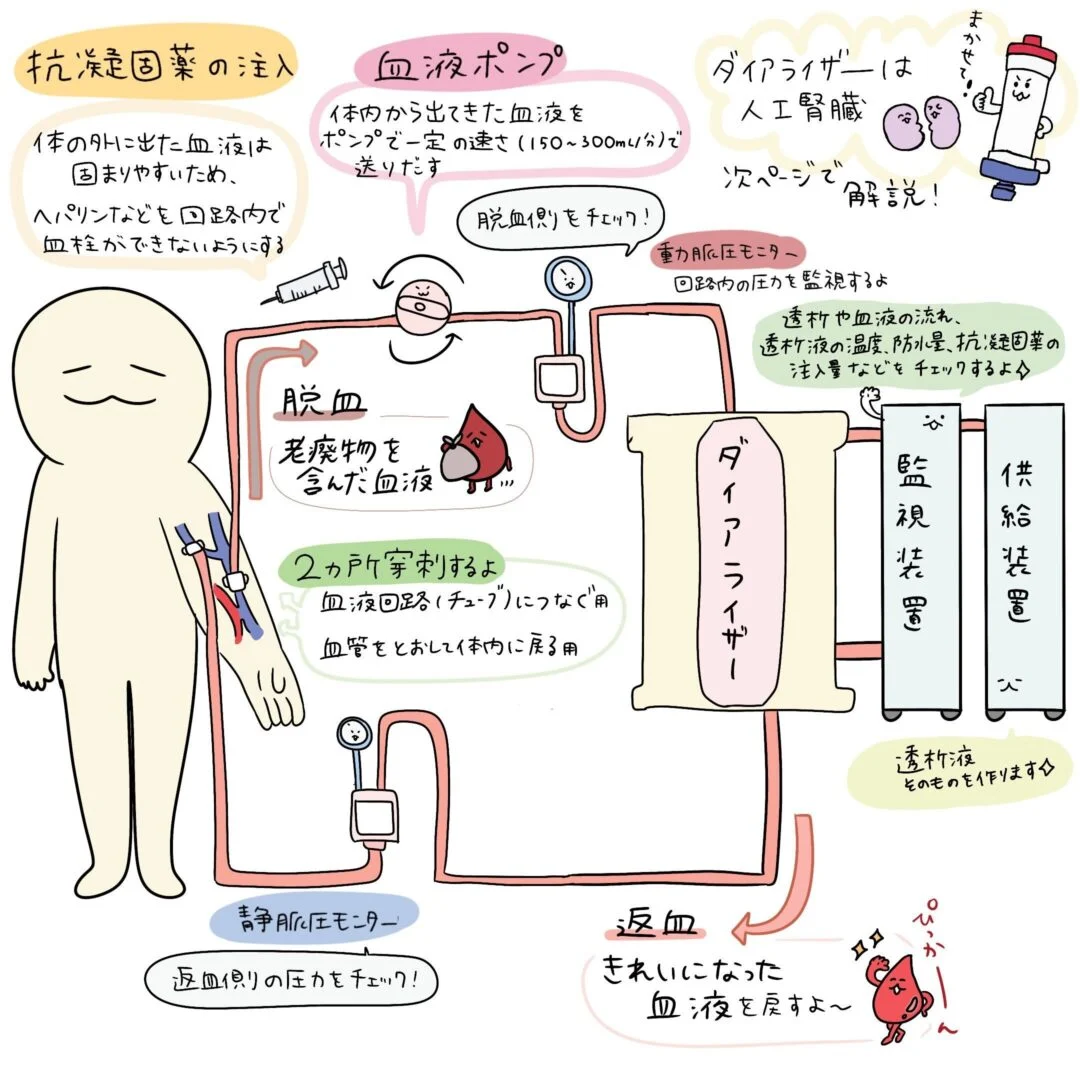 血液透析の仕組みについてのイラスト