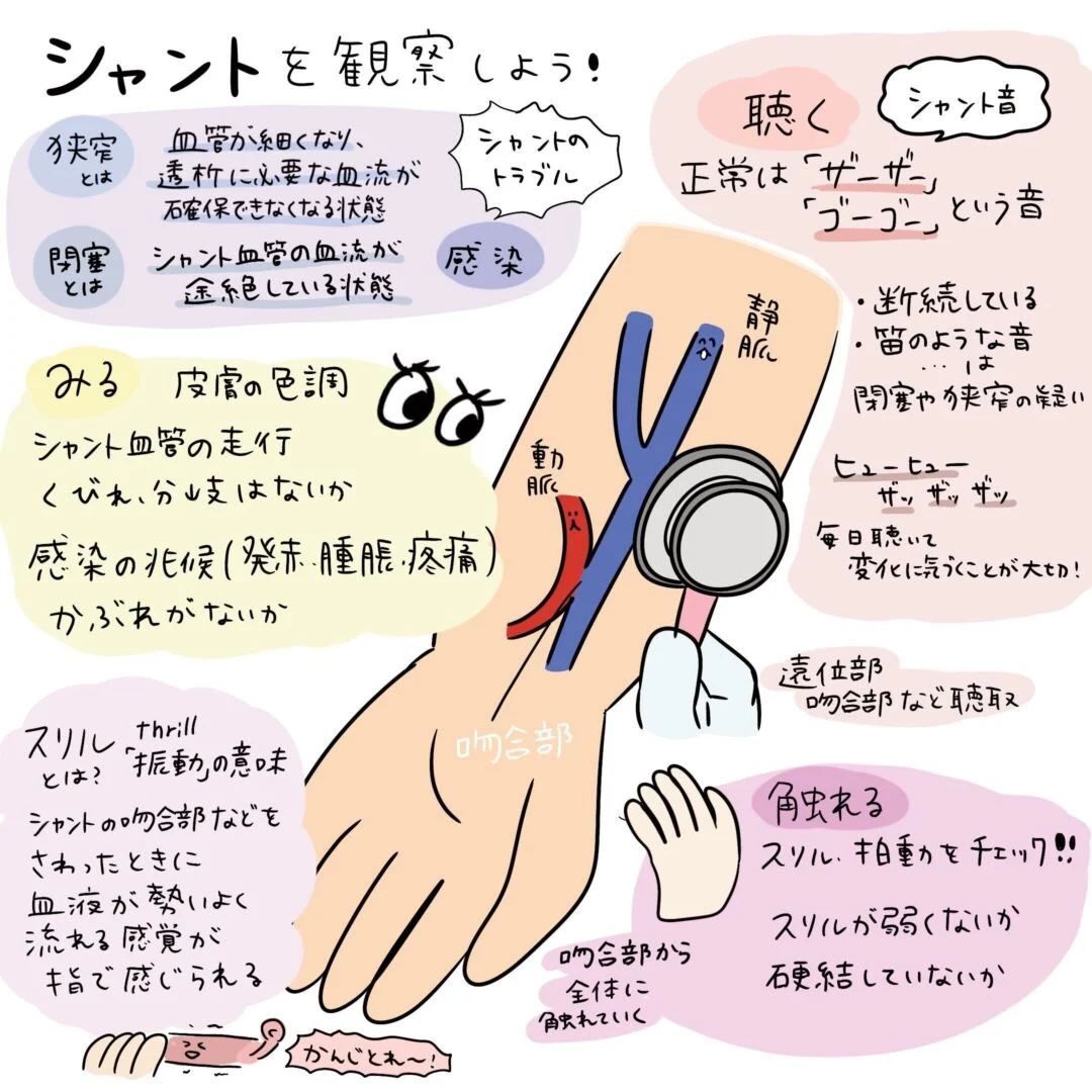 シャントの観察についてのイラスト