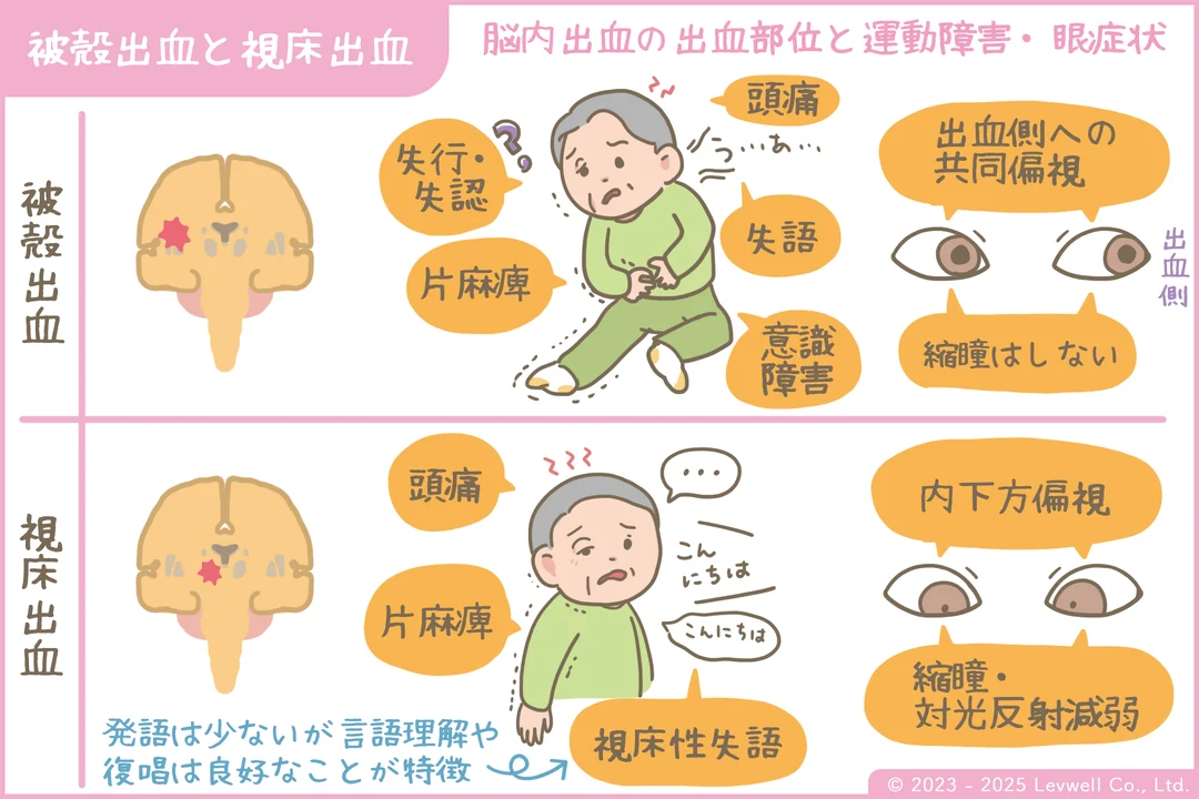 被殻出血、視床出血の解説イラスト