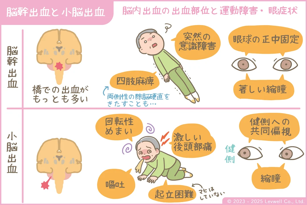 脳幹出血、小脳出血の解説イラスト