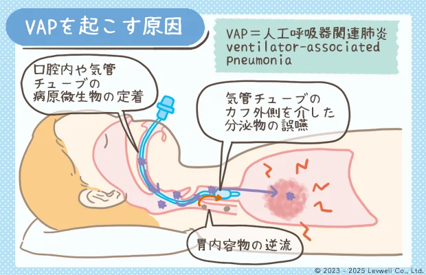 人工呼吸器関連肺炎（VAP）を起こす原因の解説イラスト