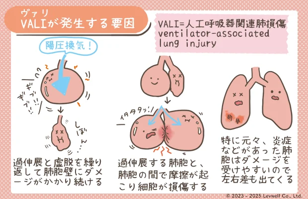 人工呼吸器関連肺損傷（VALI）が発生する要因のイラスト