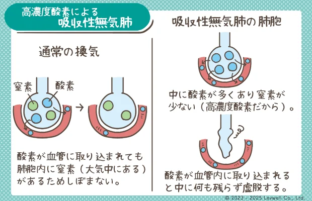 高濃度酸素による吸収性無気肺の解説イラスト