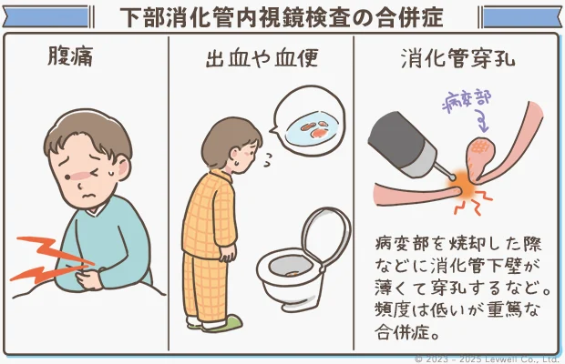 下部消化管内視鏡検査（CF）の合併症のイラスト