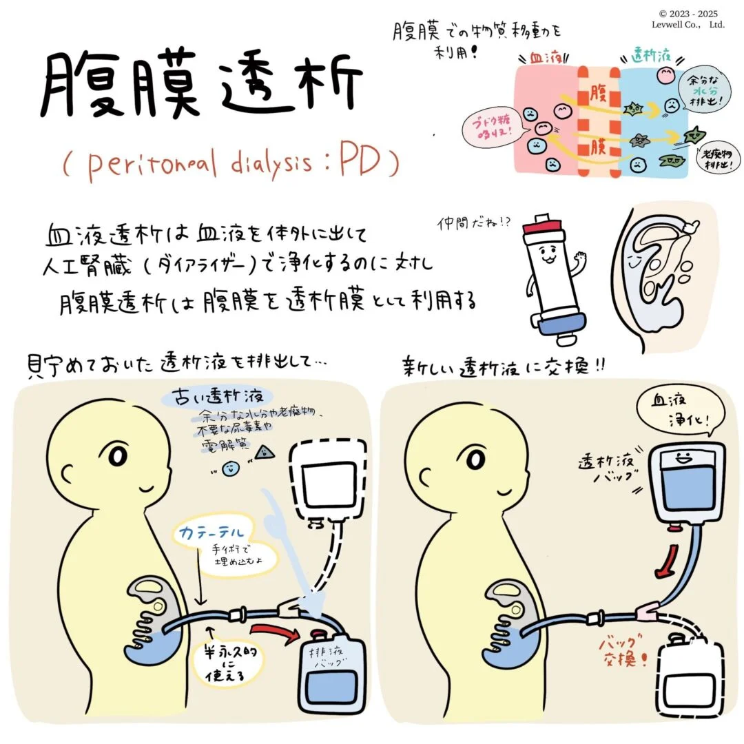 腹膜透析についてのイラスト