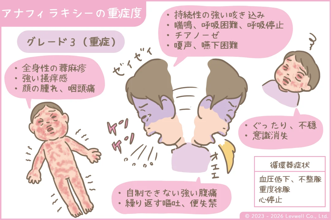 アナフィラキシーの重症度のイラスト